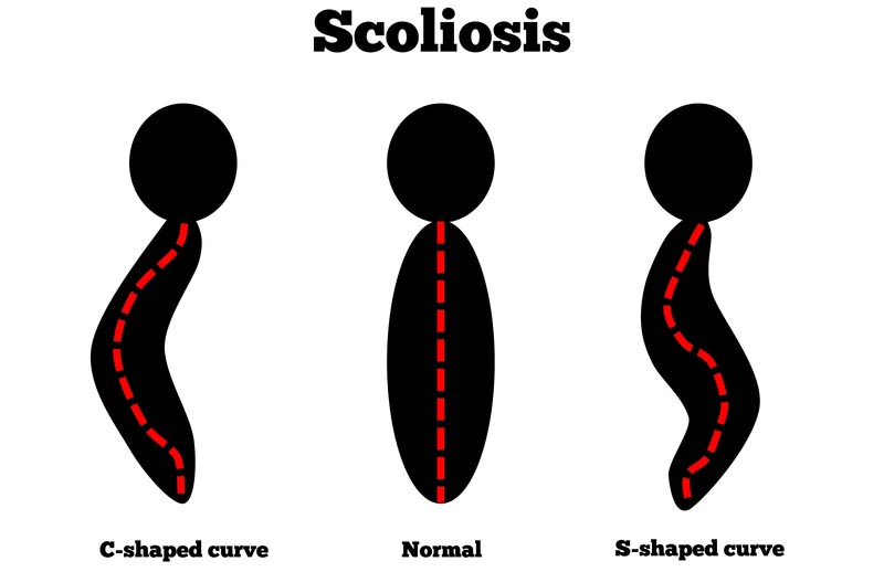 London,  scoliosis treatment